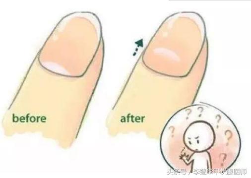 手指甲月牙越来越大代表什么,甲状腺手指月牙