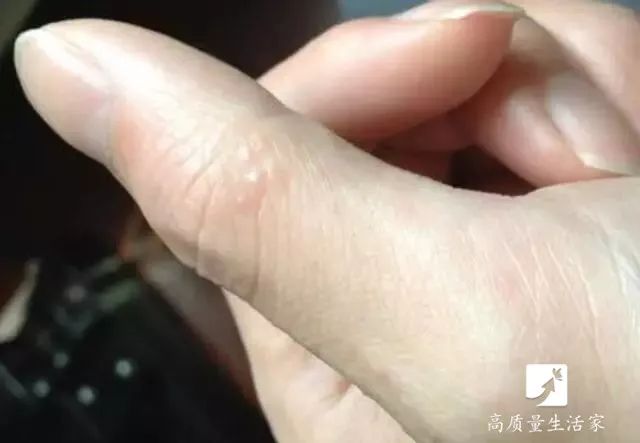 手上长水泡非常痒别抓这样处理,手上起小水泡看哪个科