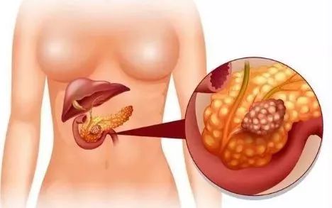 癌中之王是它这些信号要警惕,癌中之王这些症状要小心