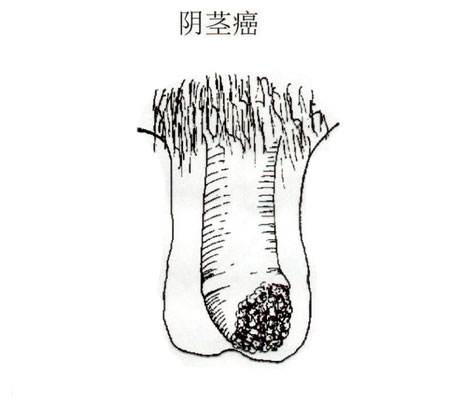 “阴茎癌”是保还是切