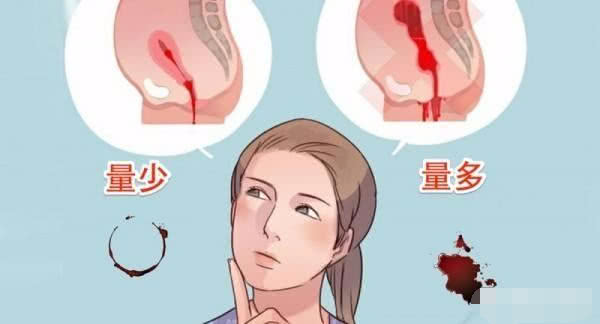 怀孕初期小腹疼痛还伴有褐色液体,怀孕初期有咖啡色液体流出