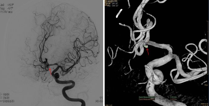 天新福-百家百言｜前交通动脉瘤再出血一例