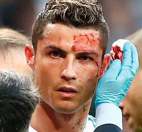 c罗受过最重的伤视频,c罗那些年欧冠