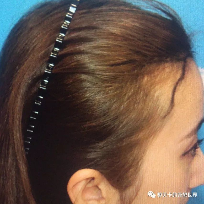 拯救发际线自己在家做,免费分享一个拯救发际线的方法