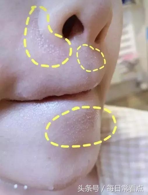嘴抿起来有小疙瘩,如何去除嘴下的小疙瘩