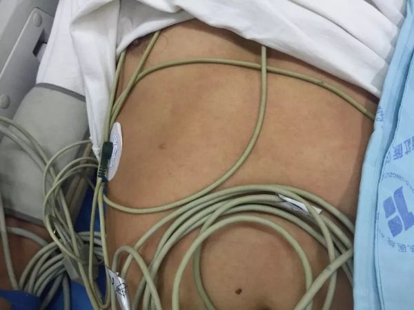 在广西被小虫子咬了怎么处理,广西女子被红蚂蚁咬后身亡