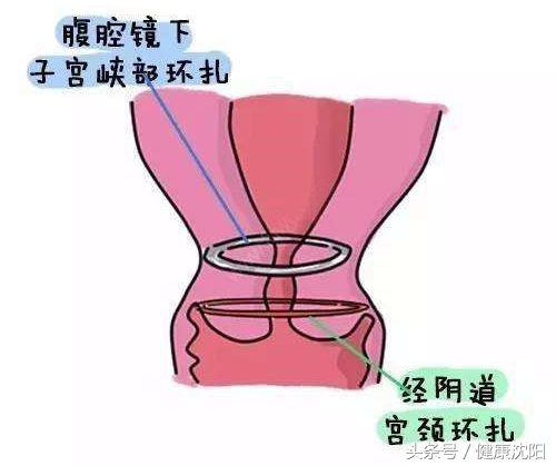 宫颈机能不全做腹腔镜环扎,孕妈课堂直播教程