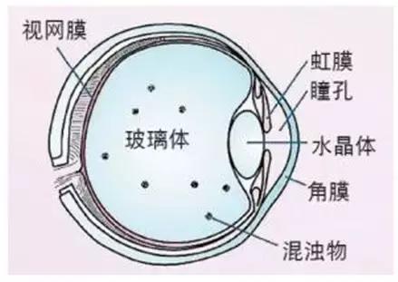 飞蚊症怎么才算严重性,飞蚊症是一个很恼人的事