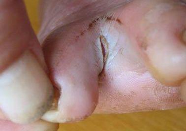 手足癣治病步骤,手足癣用什么药治疗好