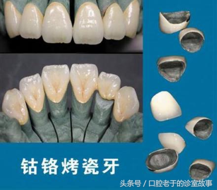 烤瓷冠什么样的最好,烤瓷冠大概多少钱一颗