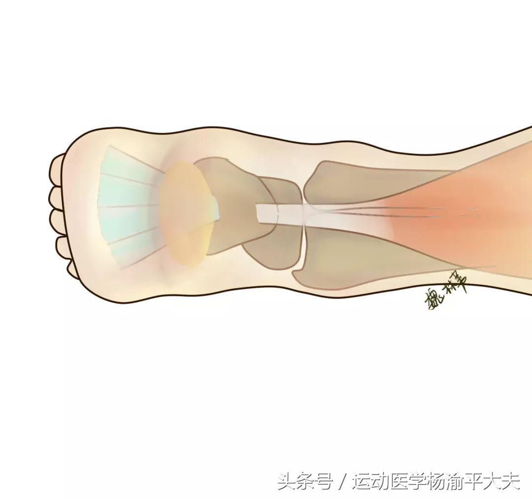 跟腱断裂保守治疗还是手术,跟腱手术干预