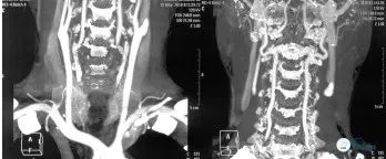 颈动脉闭塞介入治疗的风险,慢性动脉闭塞症病例