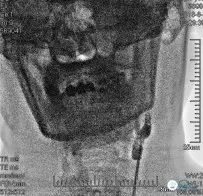 颈动脉闭塞介入治疗的风险,慢性动脉闭塞症病例