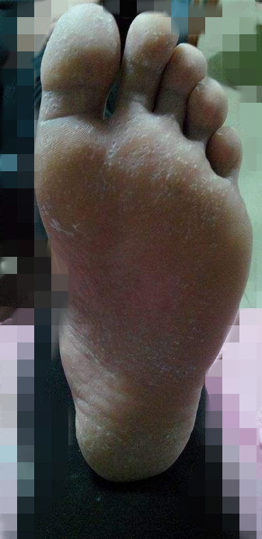 脚痒长水泡脱皮干裂要用什么方法,脚板痒脱皮长水泡是什么原因引起