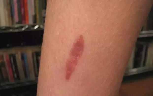 在家身上被开水烫伤后怎么急救,儿童开水烫伤急救处理