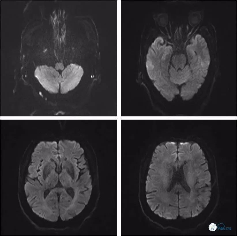 天坛周记｜左椎动脉开口及基底动脉串联狭窄血管内介入治疗1例