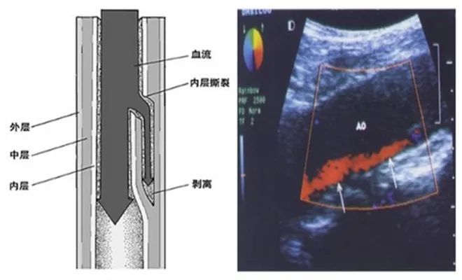 穿刺股动脉并发症,穿刺部位并发症预防及处理
