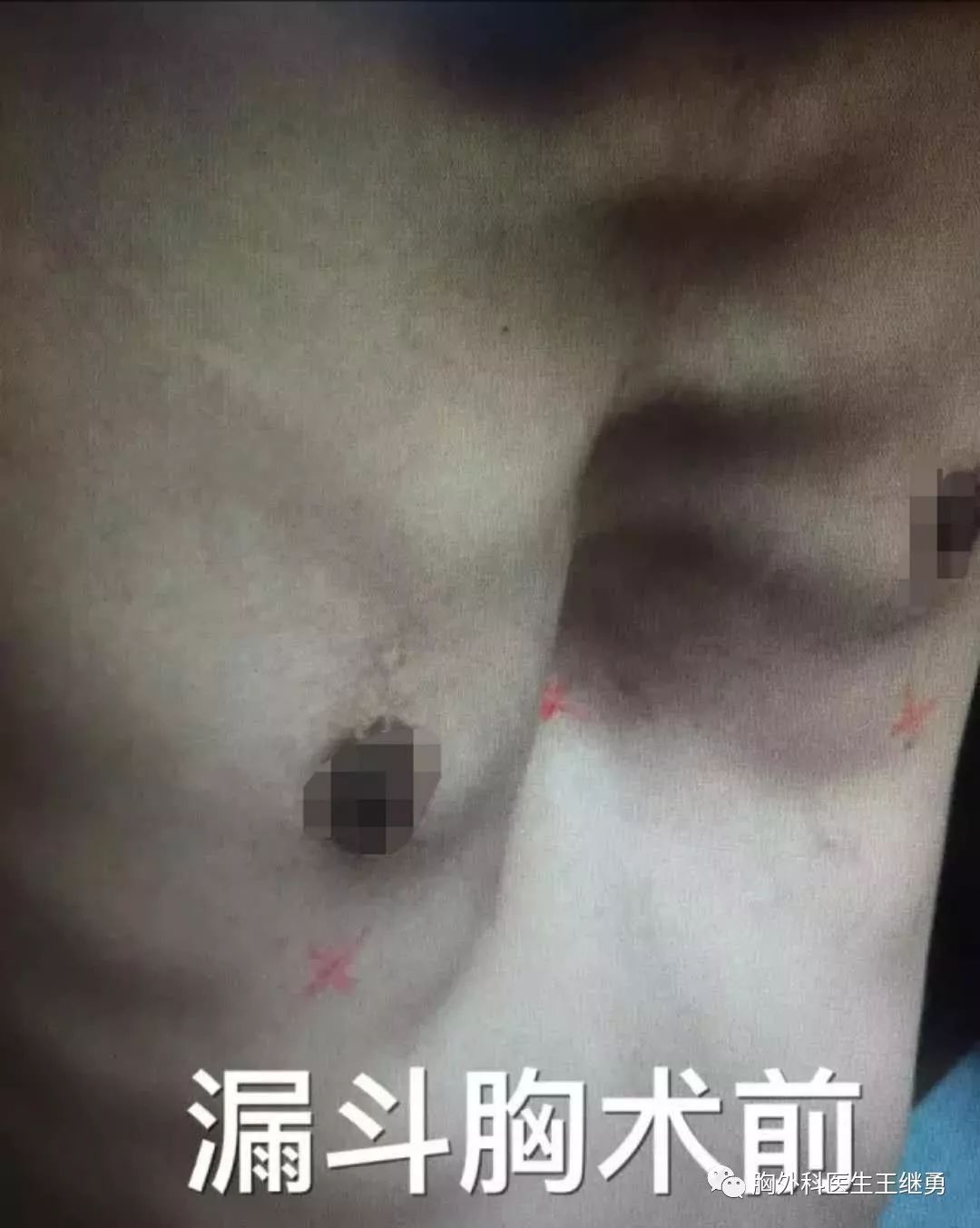 女性漏斗胸的最佳治疗方法,漏斗型胸部怎么改善