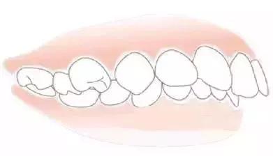 孩子换牙长歪了,如何才能让孩子安全度过换牙期?