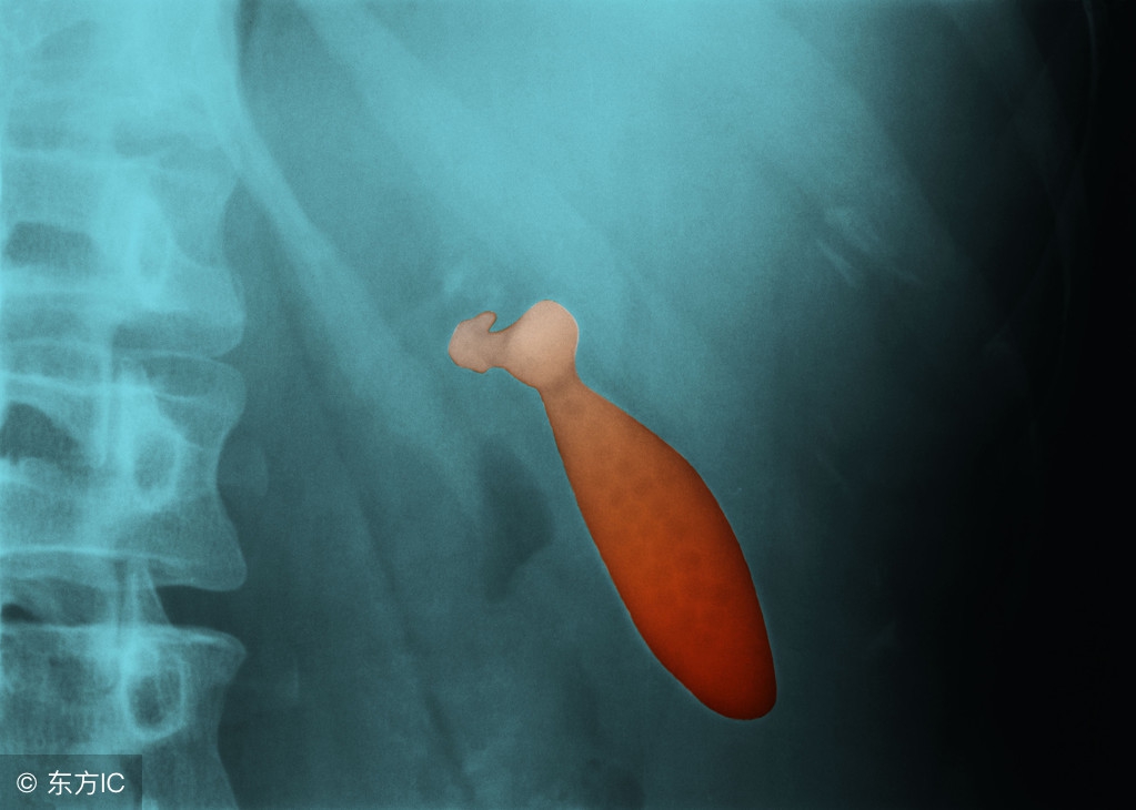 胆结石要切除肝吗,胆结石吃新鲜乌梅还是干乌梅