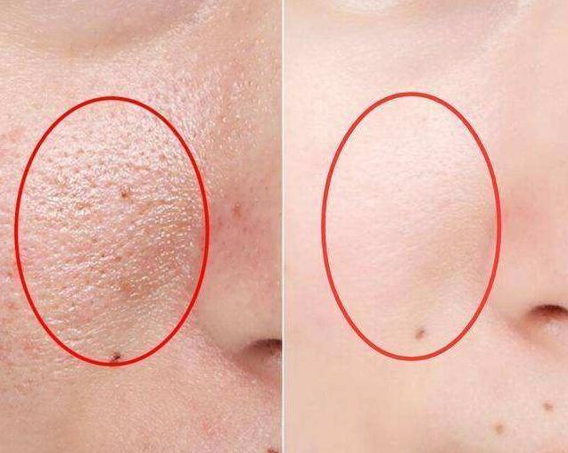 毛囊螨虫会对皮肤造成什么,毛囊里的螨虫根治的方法