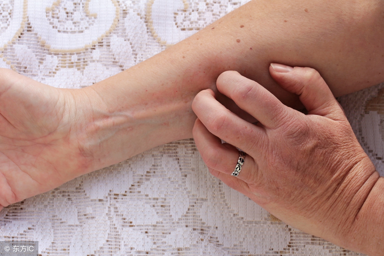 手部湿疹和脚底湿疹,手部有湿疹是怎么引起的