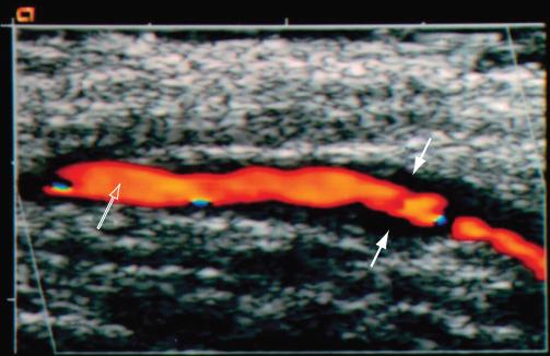 老年不明原因发热,老年人无症状发烧是怎么回事