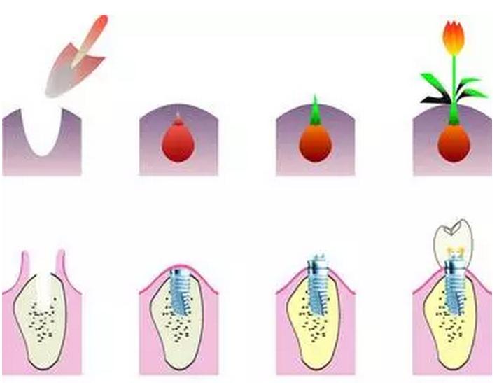 为什么牙科种植牙那么贵,为什么口腔医院都推荐种植牙