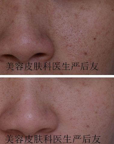 毛孔粗大如何治疗最好最快,如何治疗黑头和毛孔粗大