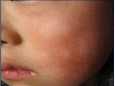 宝宝积食会导致全身皮肤黄吗,宝宝积食会导致脸上长小疙瘩吗