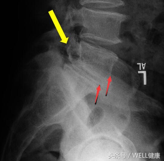 腰神经根受压可以恢复吗,腰突神经根受压和水肿一回事吗