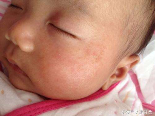 新生儿常见皮肤问题及处理,皮肤问题的根源和原因