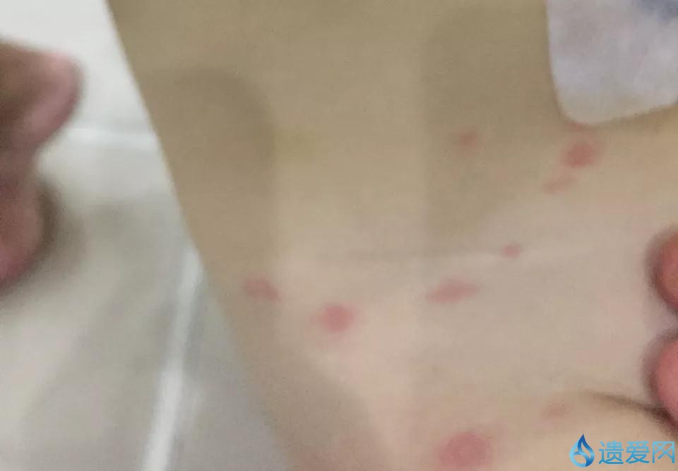 小孩子艾灸被烫伤会留疤吗,幼儿艾灸轻微烫伤咋处理