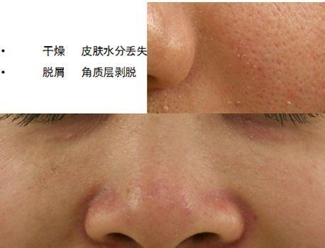 敏感性皮肤用什么化妆品好,敏感性皮肤的特征是什么