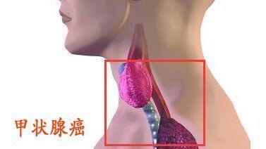 甲状腺良性结节是否会转变为甲状腺癌?甲状腺癌怎么办?