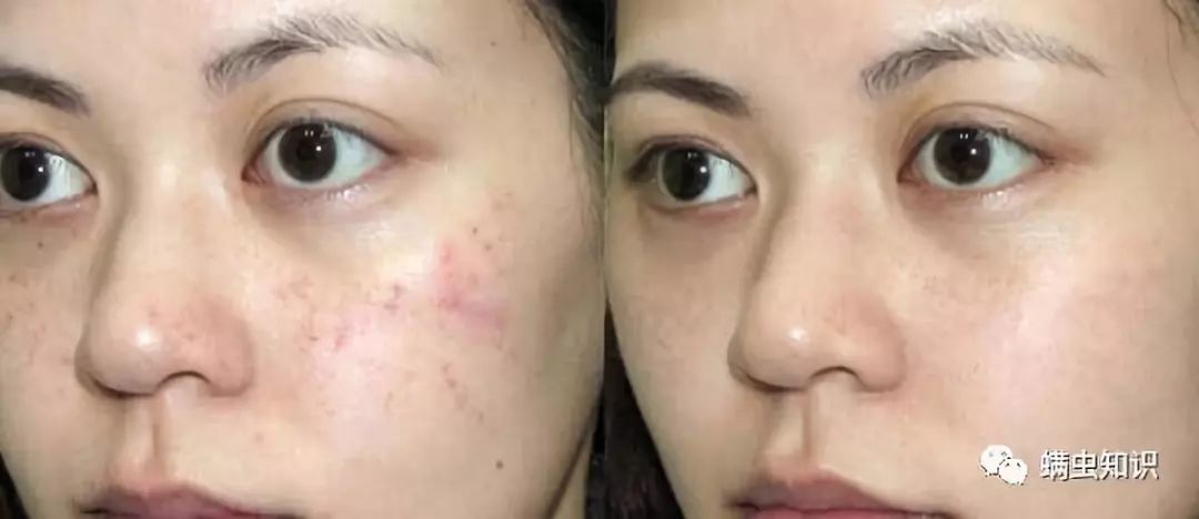 一换季就长痘怎么办,一换季就长痘痘还痒