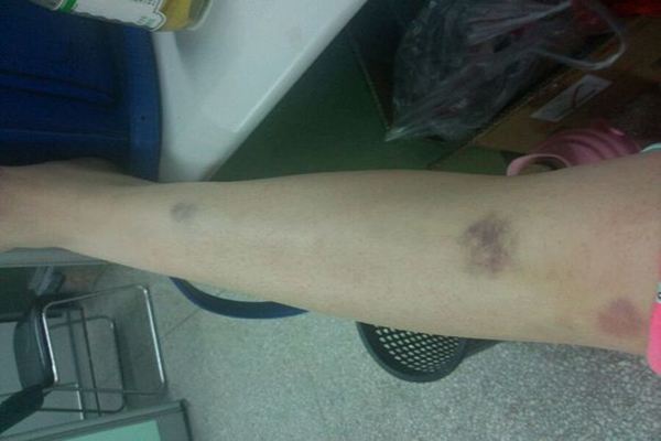 皮肤紫色瘀斑怎么快速恢复,瘀点瘀斑是哪个疾病的特点