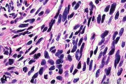 低分化癌是什么意思，这样的癌好治疗吗？低分化治疗效果一定差吗