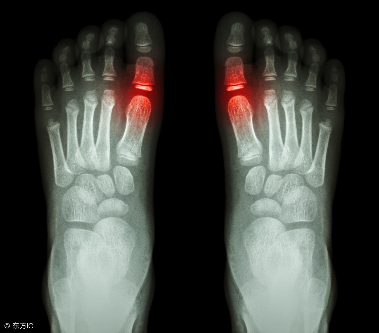 别嘌醇片和非布司他哪种降尿酸好,非布司他和别嘌醇治痛风哪个好