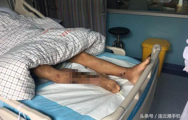 男子被虾扎手抢救无效身亡,男子被虾扎手后续