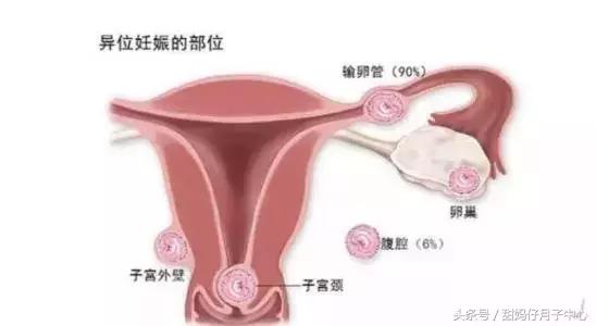 孕期流血是流产的征兆吗,孕期流血是卵黄囊掉了吗