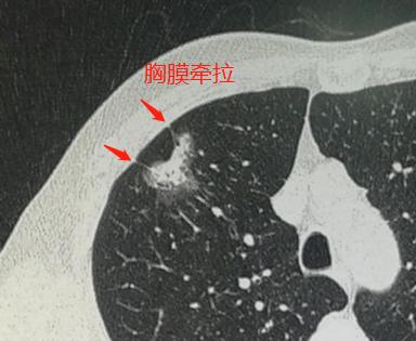 磨玻璃肺结节手术后需要化疗吗,2.5厘米肺结节微创手术后要化疗吗