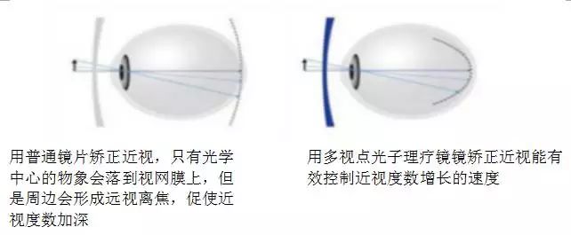 眼科教授谈青少年近视的原因,专家谈眼睛近视危害