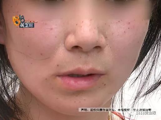 杭州点痣女生,去医院取痣花了1000多元