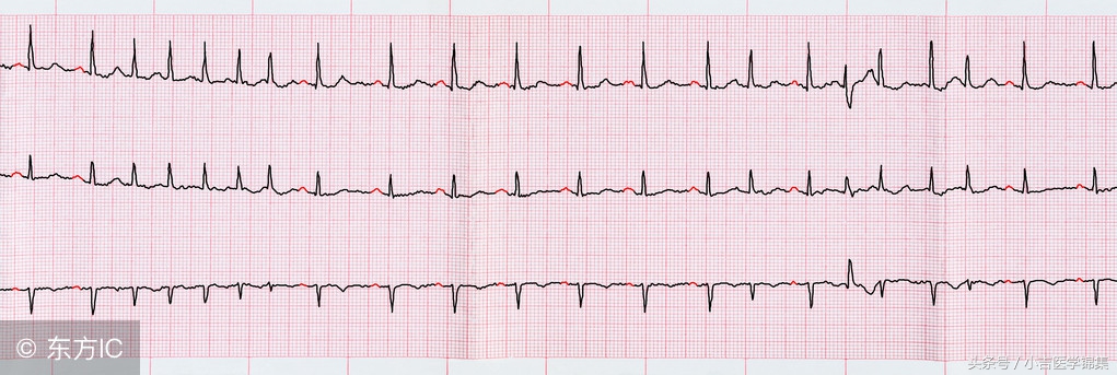 房颤的治疗方法,房颤的治疗方法消融术