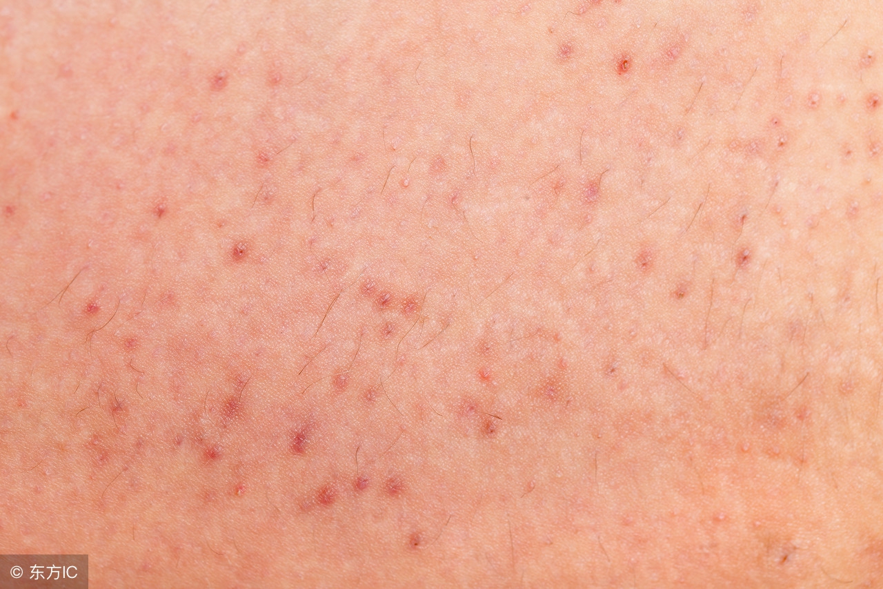 毛囊炎和疮的区别,毛囊炎是疮疖类皮肤病吗