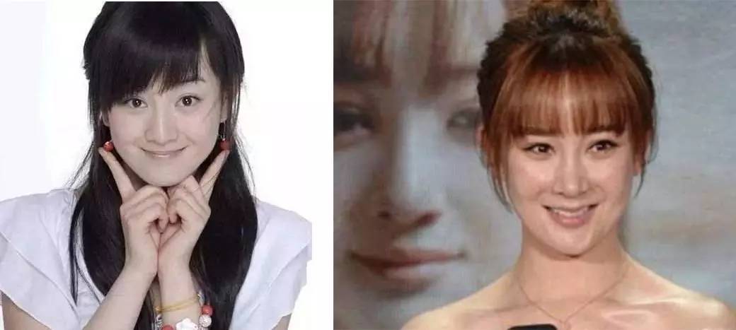 有人劝你打玻尿酸,打玻尿酸的一些常识问题