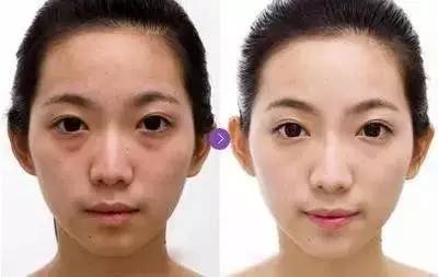 有人劝你打玻尿酸,打玻尿酸的一些常识问题