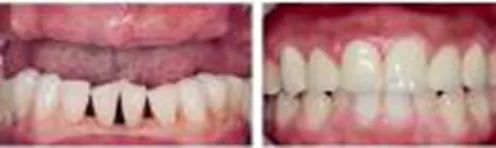 牙齿矫正8月最新价格,2024年30岁牙齿矫正费用多少钱