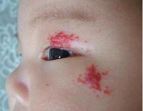 痣发红寓意,痣发红发痒怎么回事